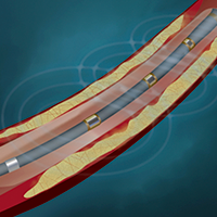 Evaluation of the IVUS Calcium Scoring System in Guiding Intravascular Lithotripsy During PCI