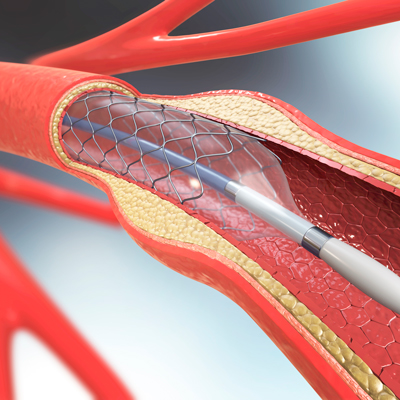 Temporal Trends, Characteristics, and Outcomes of Patients Undergoing PCI for Stent Thrombosis: The NCDR CathPCI Registry